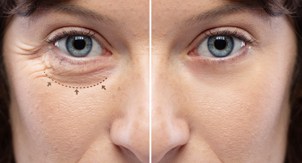 blefaroplastia