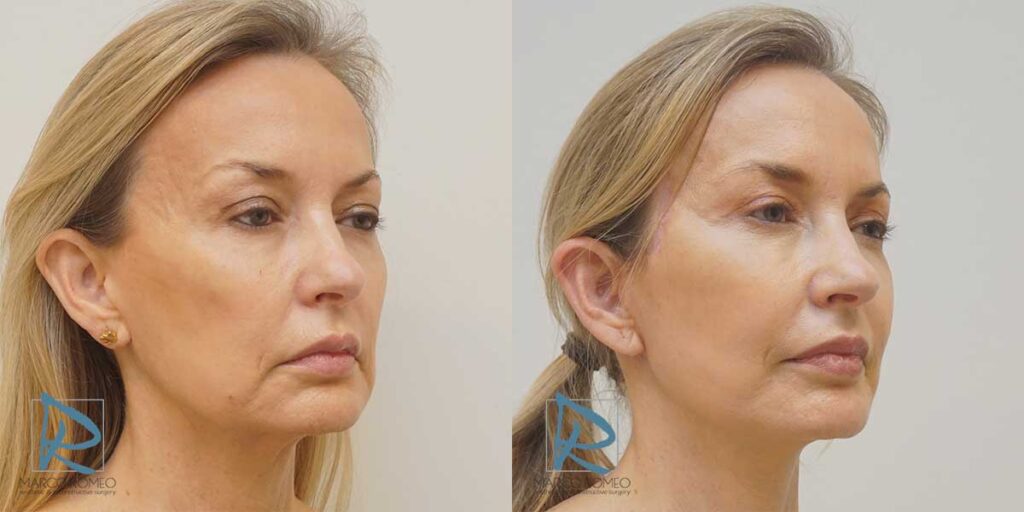 lifting-facial
