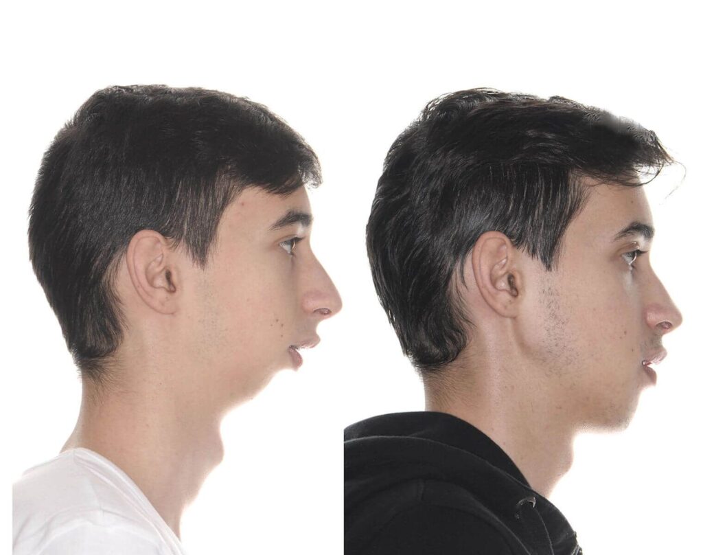 mentoplastia